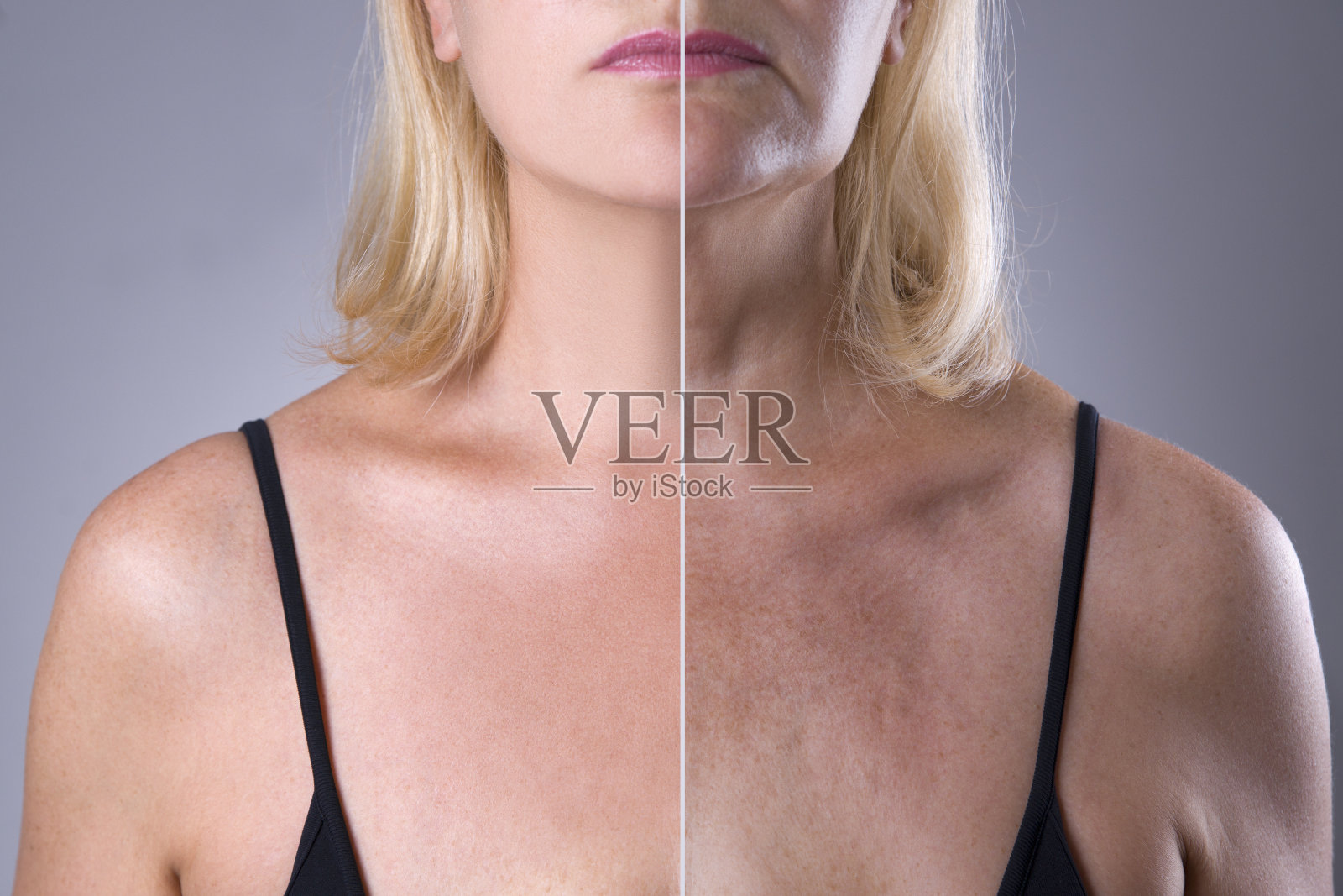 女性皮肤前拉皮和整形手术后，除皱治疗照片摄影图片