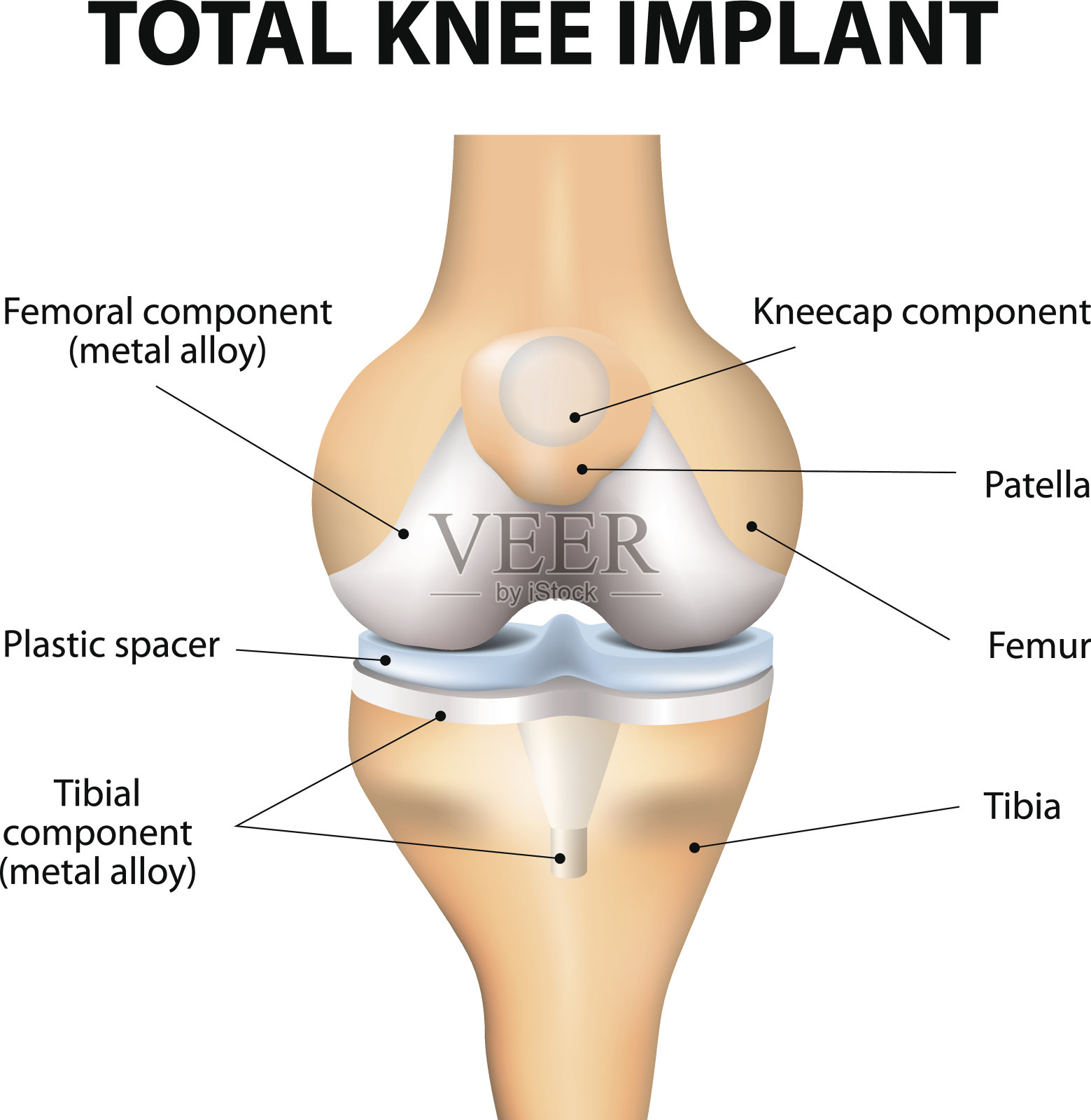 膝关节置换术组件插画图片素材