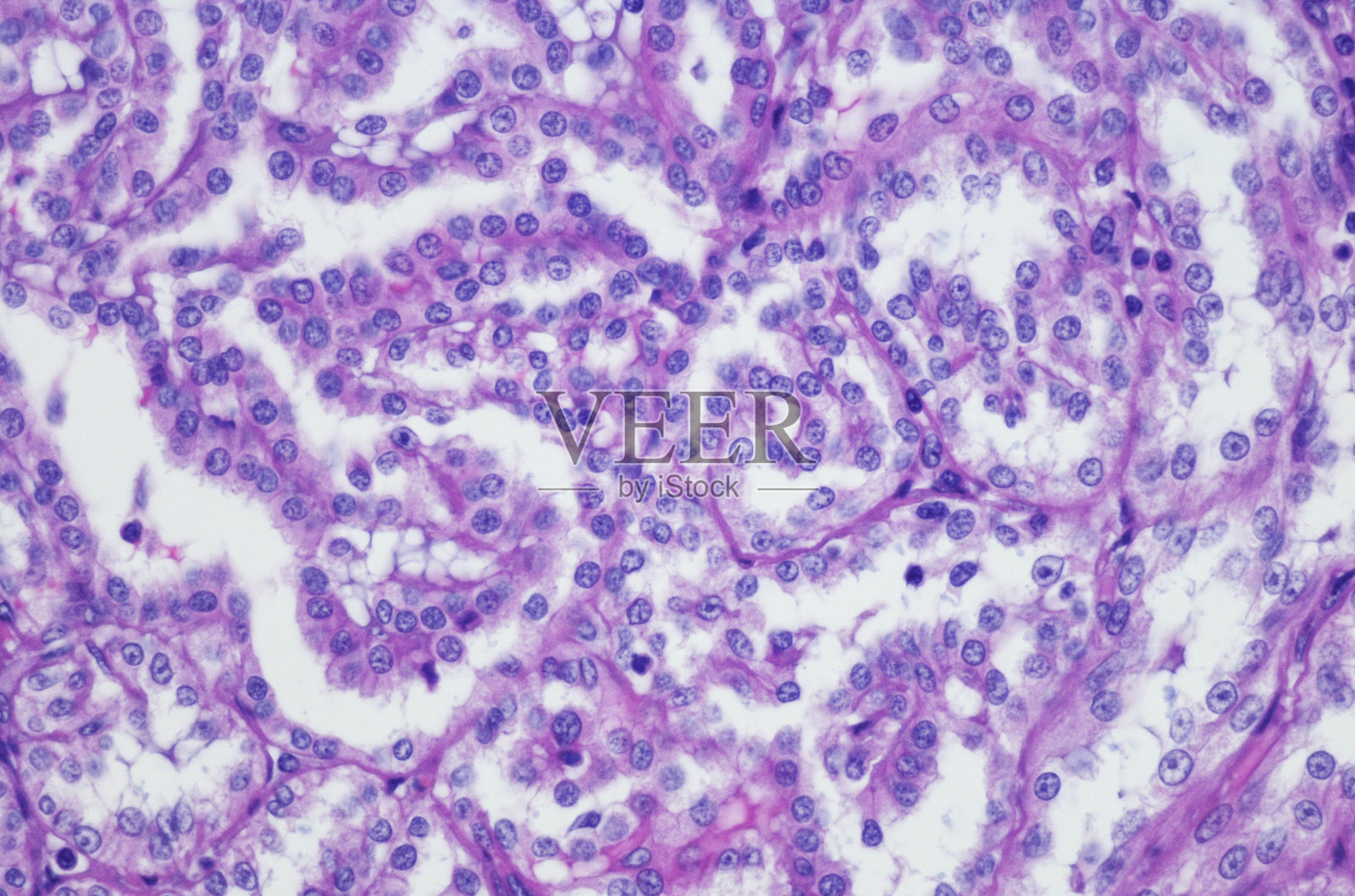 肾黏液小管细胞癌照片摄影图片