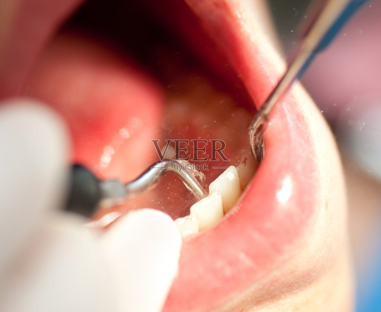 在牙医的牙垢清除- Zahnsteinentfernung照片摄影图片