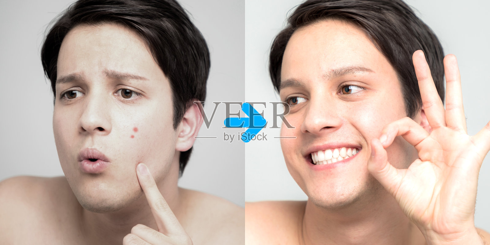 男士青春痘治疗前后形象，青春痘治疗，男士皮肤护理照片摄影图片