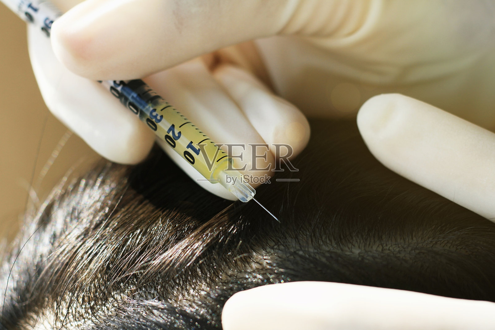 医生在病人的头发和头皮注射，皮肤科医生检查头皮疾病。照片摄影图片