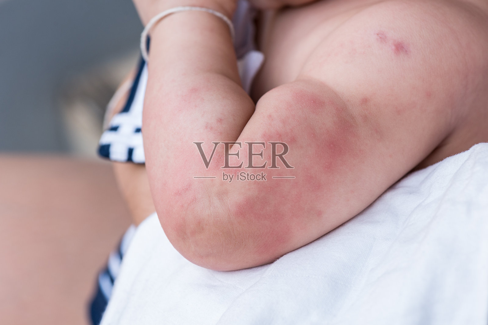 婴儿皮肤质地患严重荨麻疹、荨麻疹。照片摄影图片