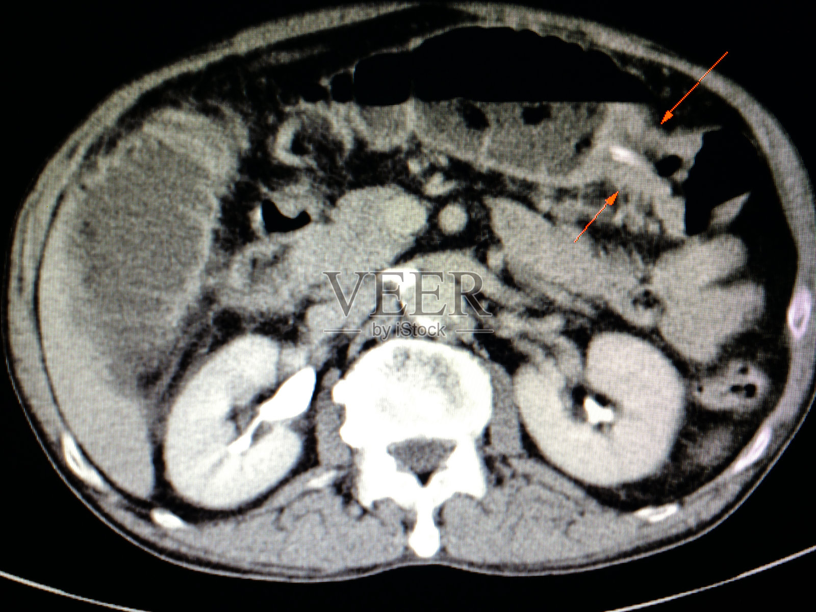 结肠癌的CT诊断照片摄影图片