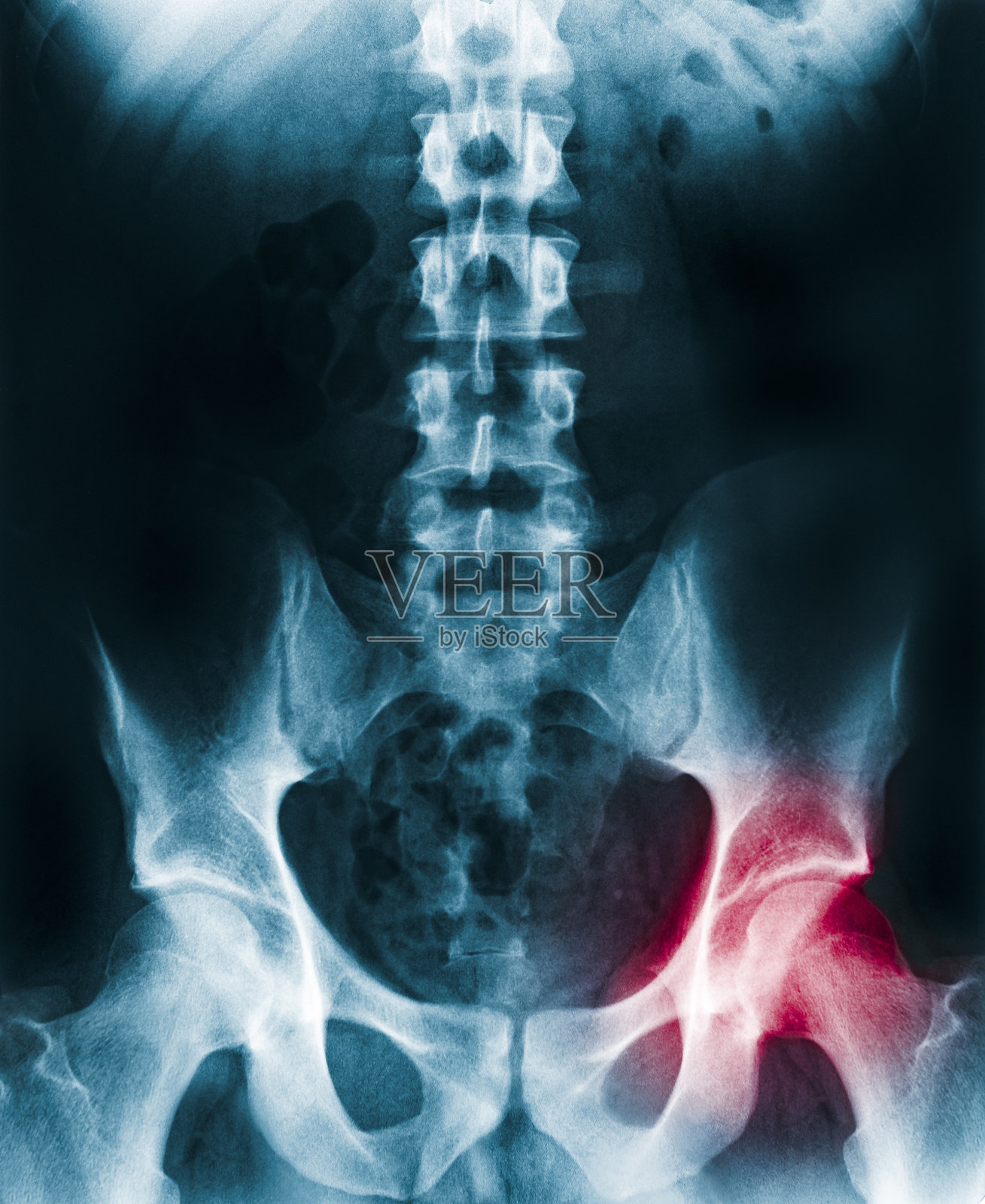 人类骨盆、脊柱和臀部的x光片，左髋关节用红色突出显示照片摄影图片
