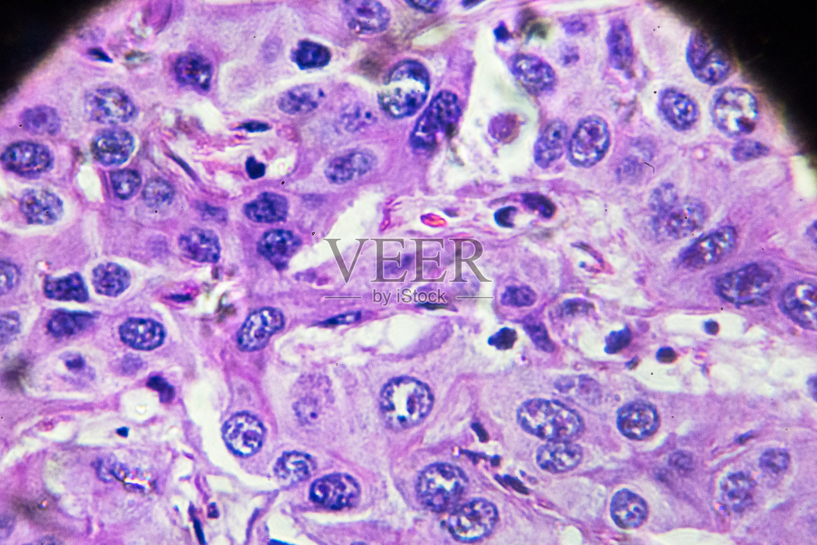 肝细胞癌，显微镜下的HCC照片摄影图片