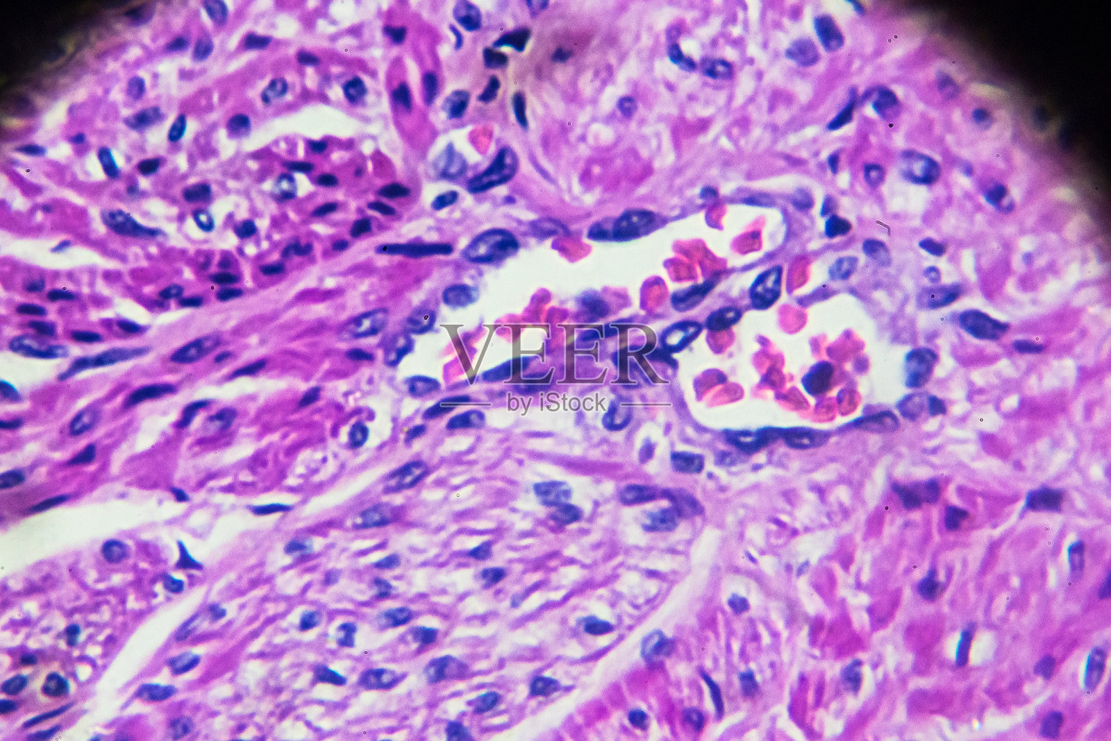 显微镜下子宫内膜癌生物样本照片摄影图片