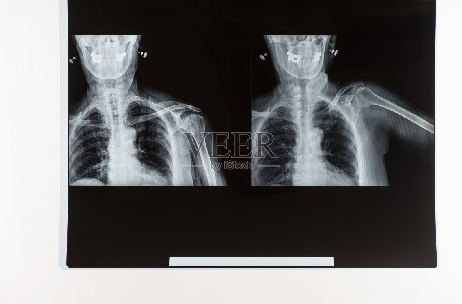 x射线的骨架照片摄影图片