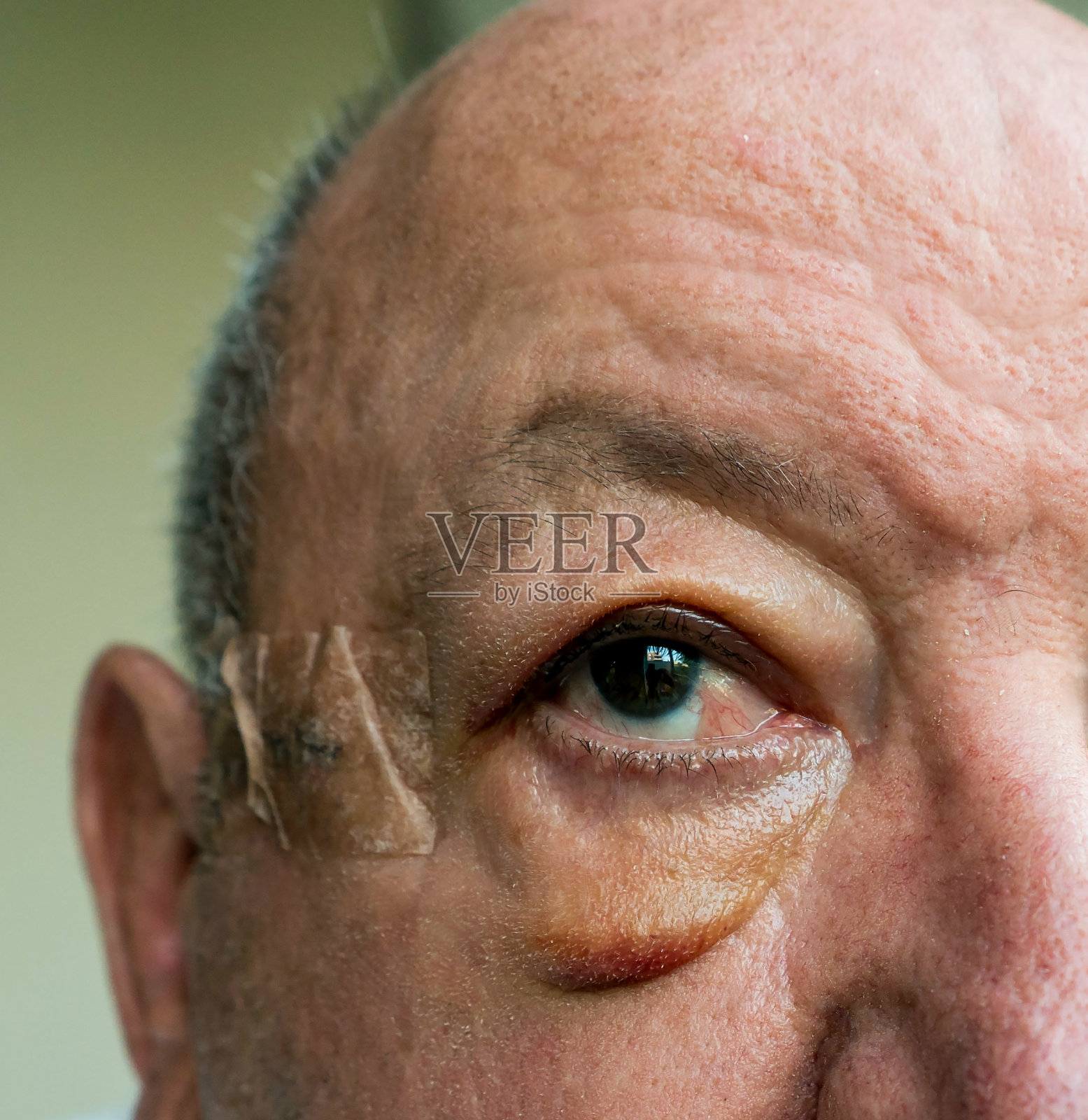 手术后老年男性面部水肿的特写照片摄影图片