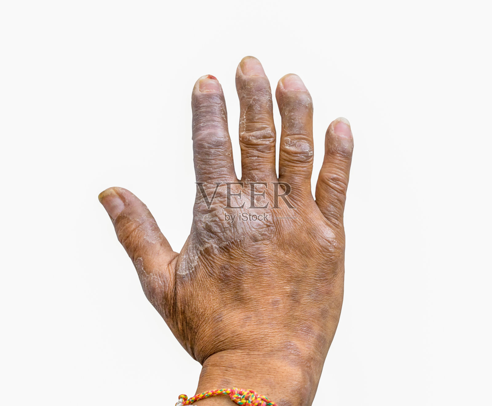 近距离观察银屑病患者手上的白斑背景，皮肤病。牛皮癣的手指畸形。照片摄影图片