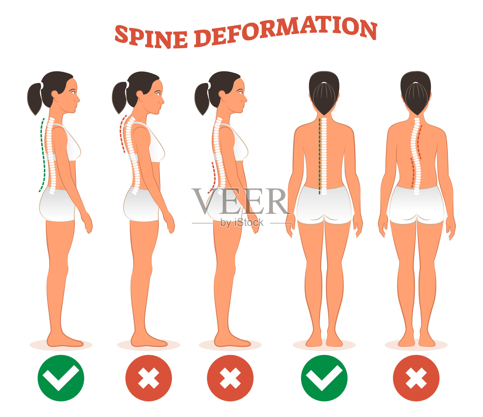 脊柱变形类型与健康脊柱对比图海报。插画图片素材