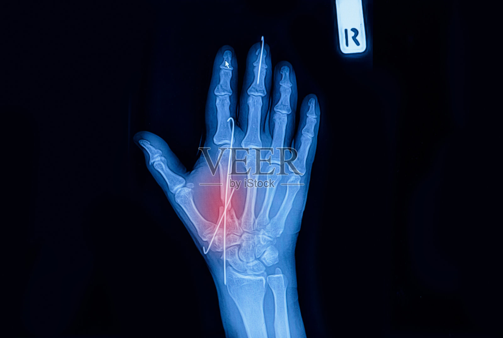 人体手部的x光图像显示植入物造成的骨折照片摄影图片