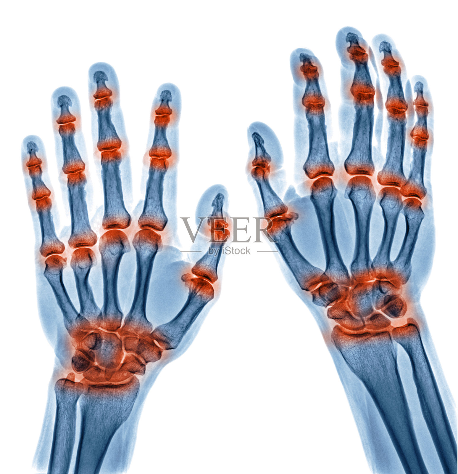 由痛风性关节炎引起的双手多关节炎症的x线图像，类风湿性关节炎孤立在白色背景上照片摄影图片