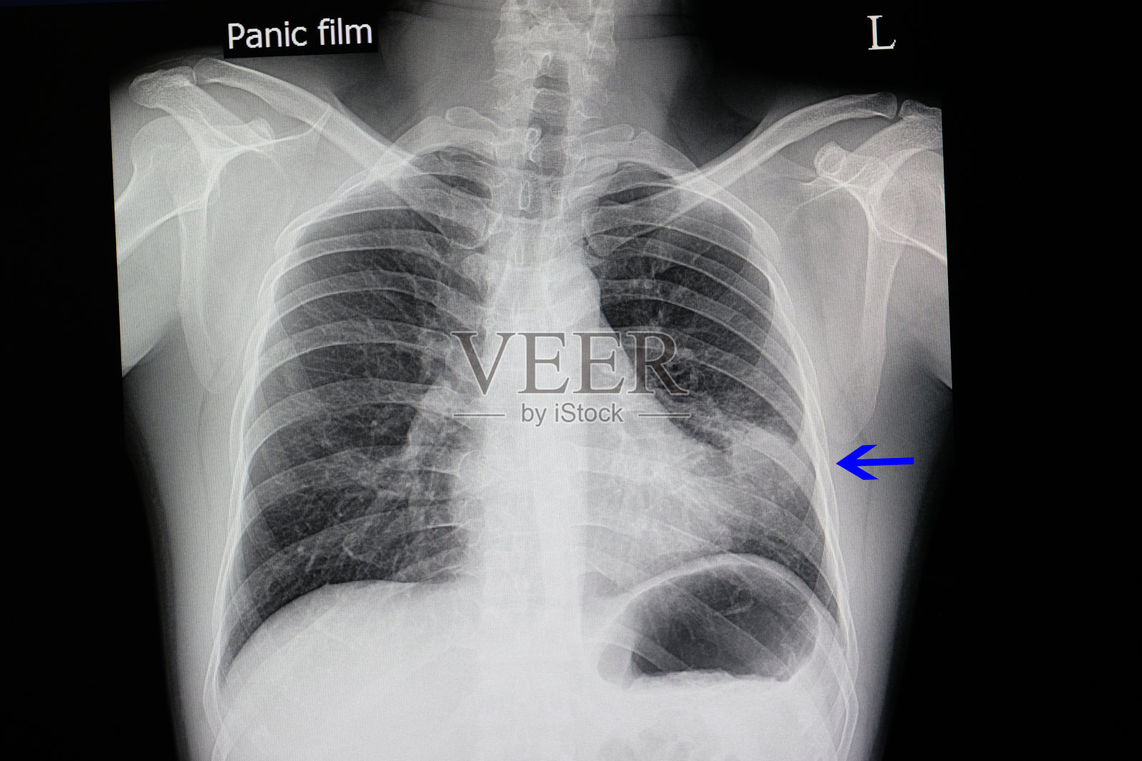 一位肺炎病人照片摄影图片