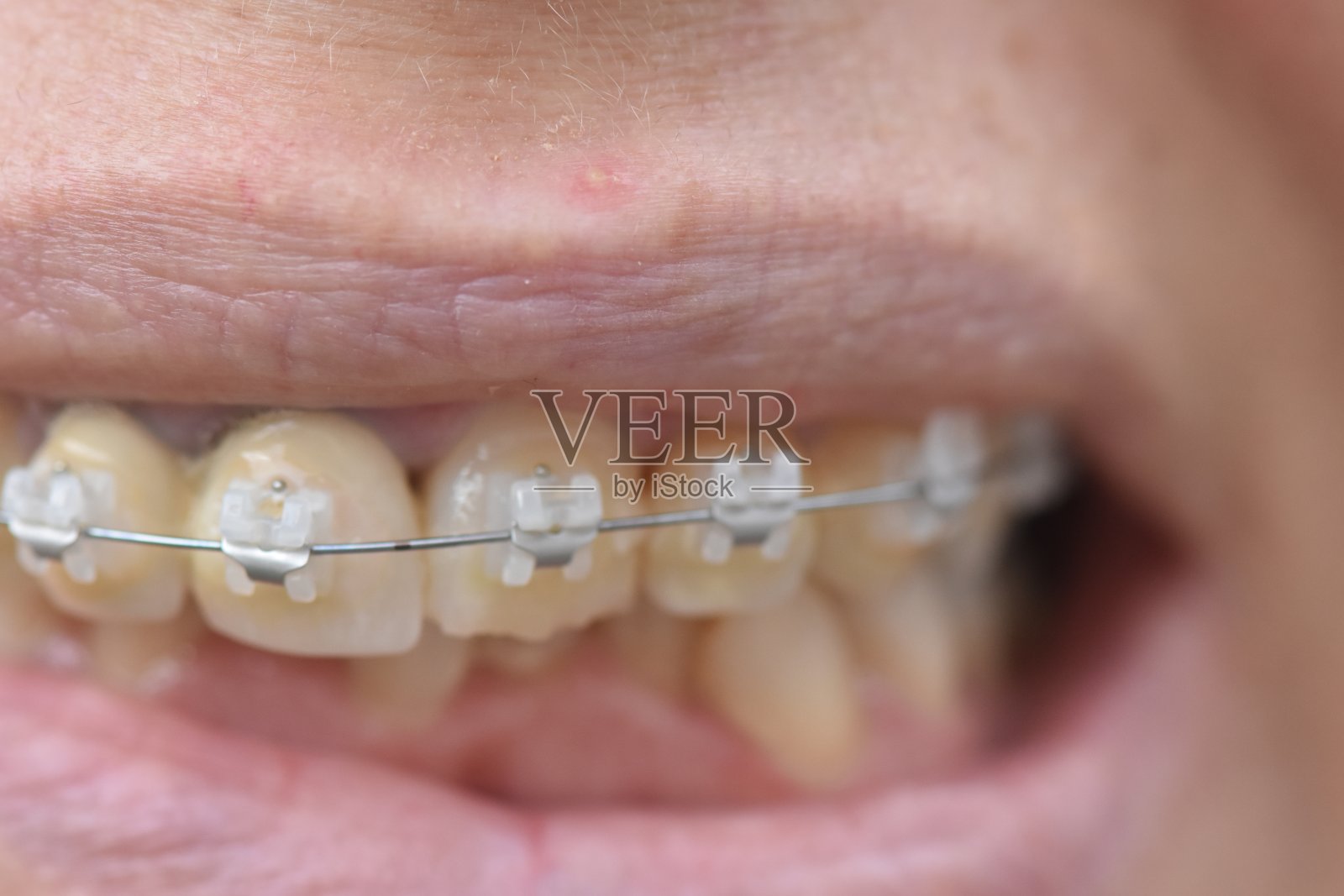 女人的微笑和牙齿上的牙齿矫正器照片摄影图片