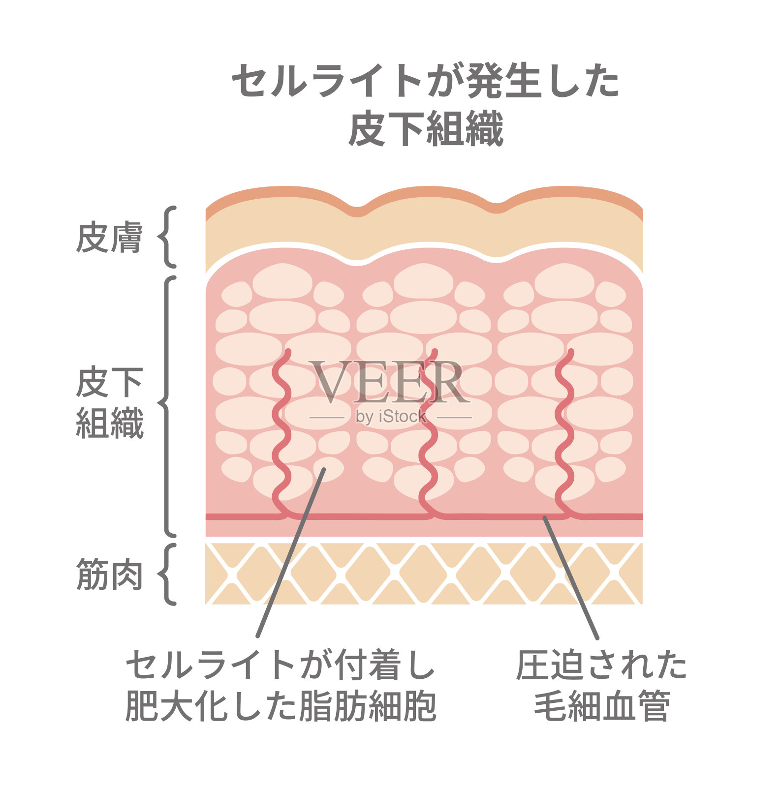 脂肪团皮肤插图(日语)插画图片素材
