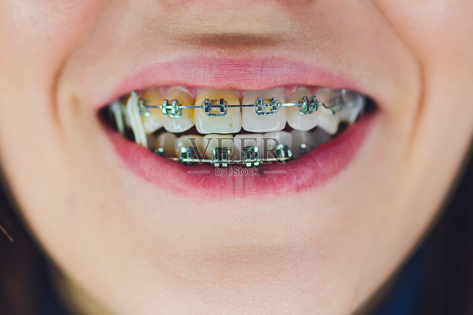 牙齿有牙套和松紧带。牙科医生进行牙齿美白。一半牙齿脏，一半干净。照片摄影图片