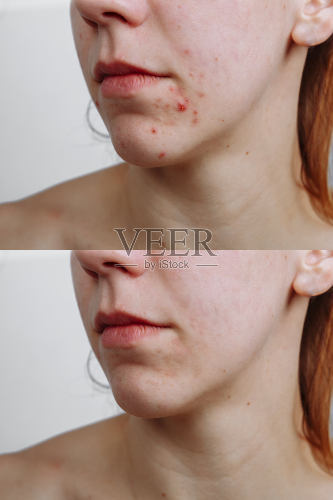 年轻女性痤疮治疗前后，特写。皮肤护理的概念照片摄影图片