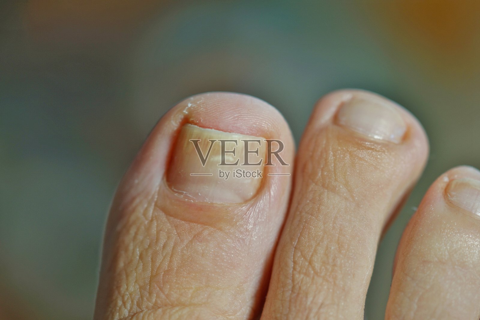患有指甲牛皮癣的脚趾。一个女人的脚趾甲长到内生了。短把指甲。性皮炎照片摄影图片