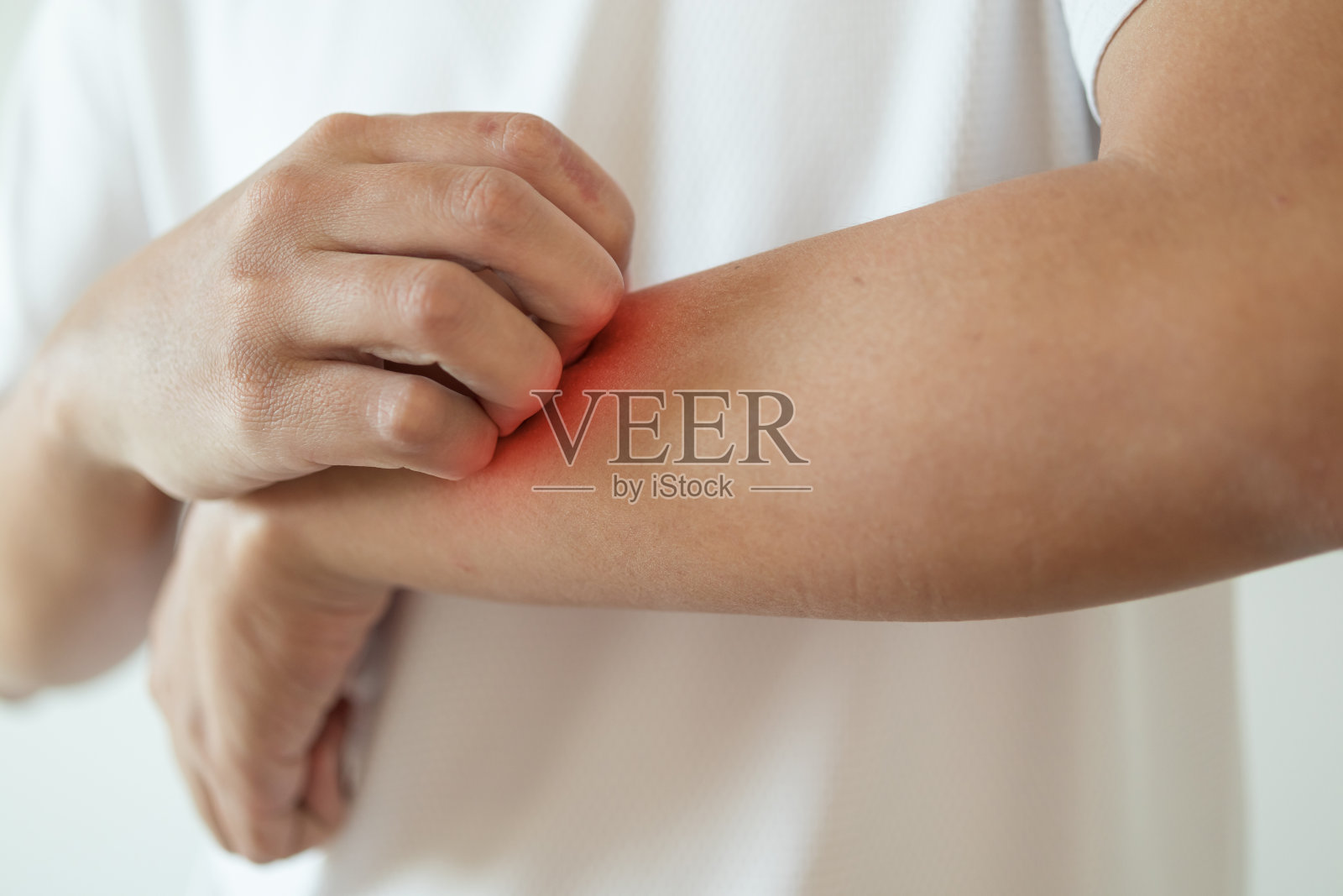男人搔痒和抓挠手臂，因皮肤瘙痒而引起干性湿疹皮炎照片摄影图片