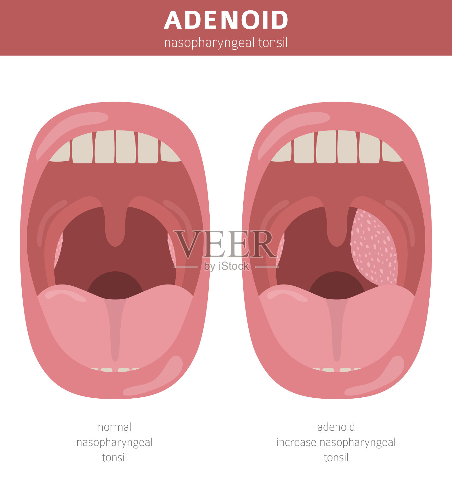 颚咽成形术（扁桃体切除）后 - 知乎
