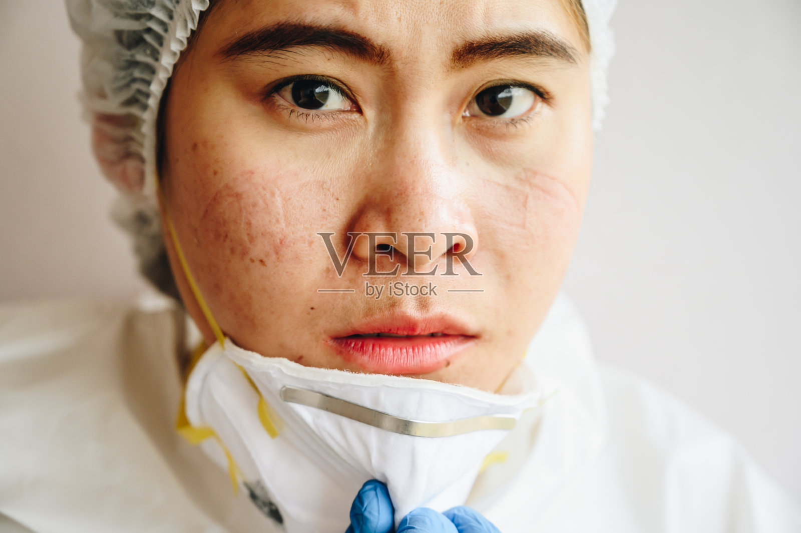 covid-19大流行期间，医护人员在医院工作后长期佩戴医用口罩，出现痤疮和面部创伤。照片摄影图片