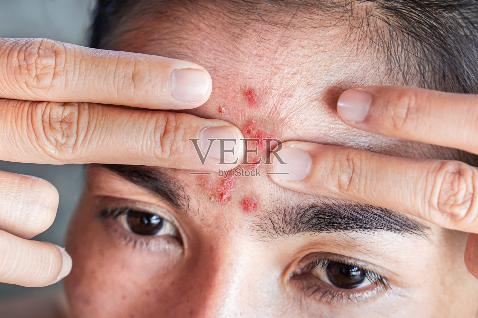 亚洲妇女有皮肤问题与痤疮脸，挤压丘疹在她的前额照片摄影图片