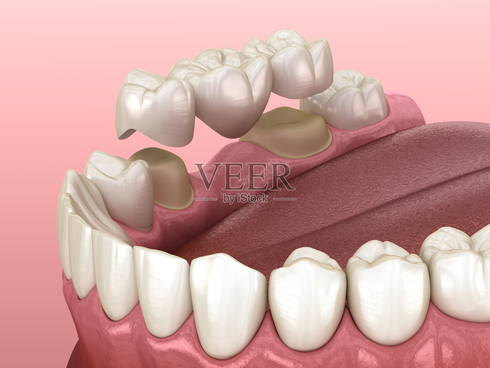 臼齿和前臼齿上有3颗牙的牙桥。医学上精确的人类牙齿治疗的3D插图照片摄影图片