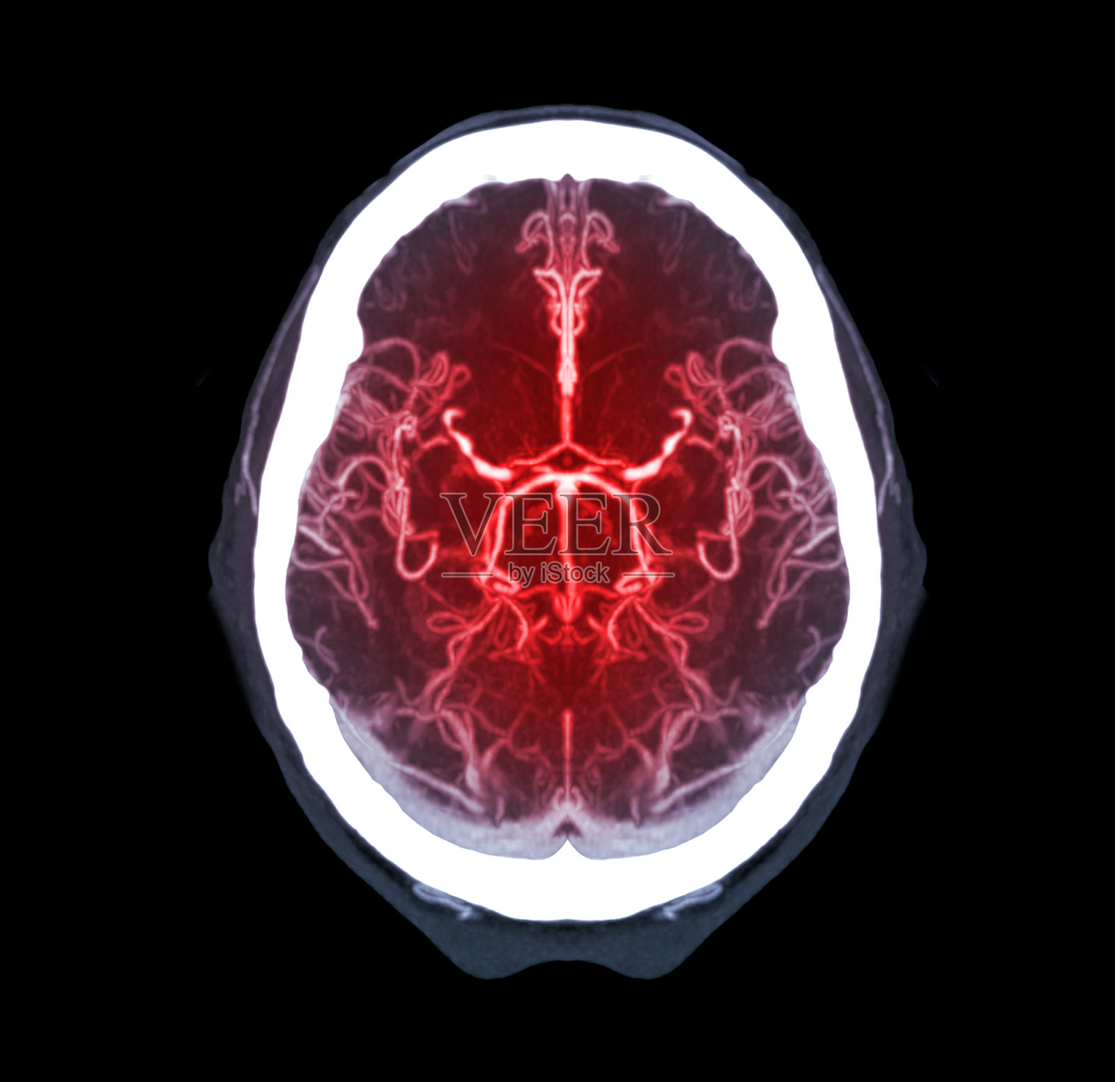颅脑 CT 读片 纯干货 - 影像核医学 -丁香园论坛